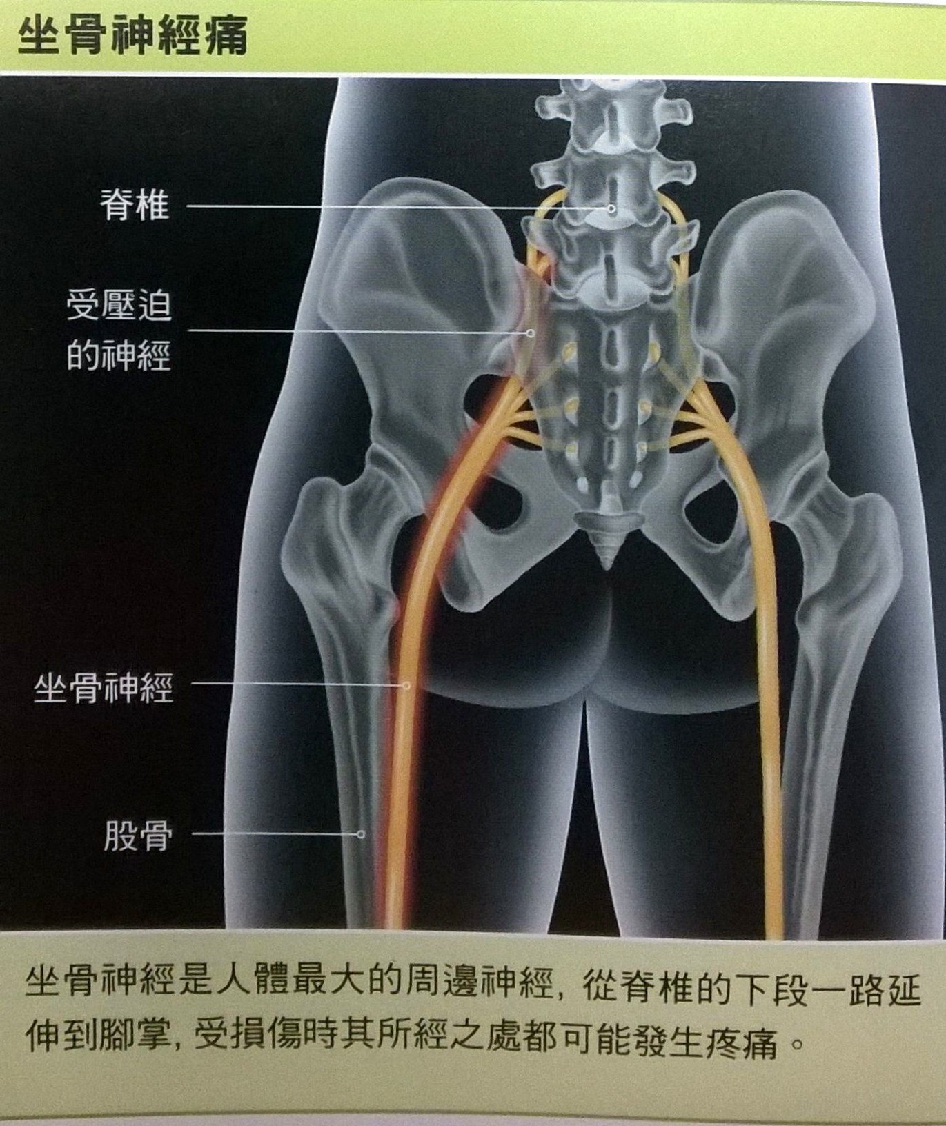如何诊断和治疗坐骨神经痛?_滨州市微创外科治疗中心-滨州万寿堂医院