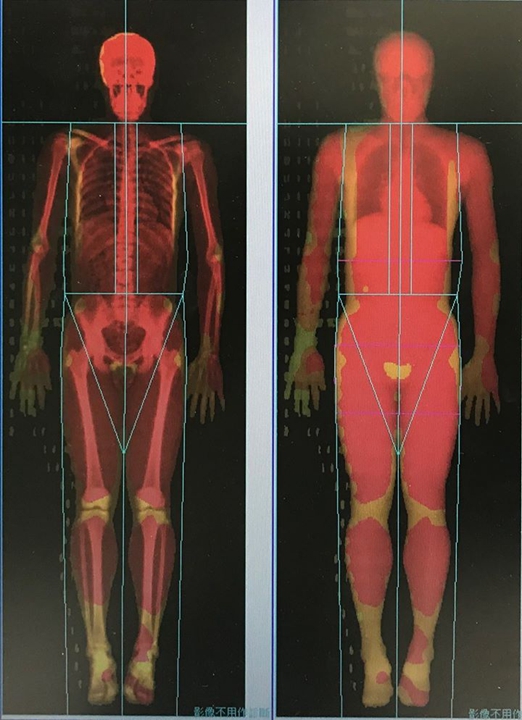 Dexa檢測身體組成，左圖表示骨密度，右圖分為組織（黃色部份，可能是體脂、水份等其他物質）與肌肉（紅色）。資料來源：北市大鐵人隊