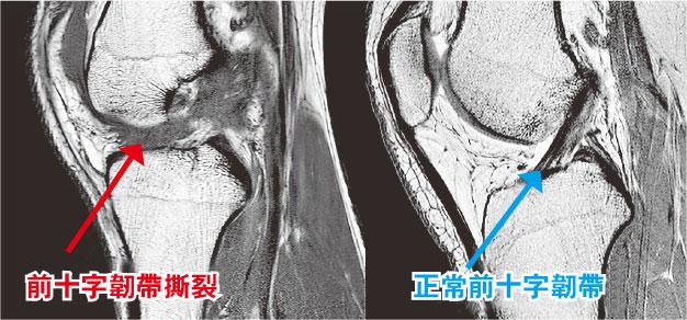 前十字韌帶正常與撕裂之差別