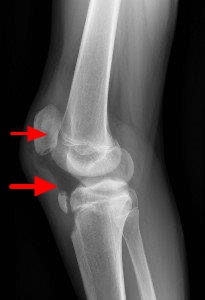 髕骨肌腱炎伴隨脛骨粗隆撕裂性骨折